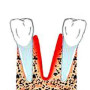 Альвеолит лунки зуба