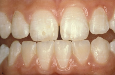 Зубы при флюорозе