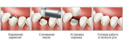 установка керамических зубов