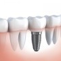имплантант на зуб