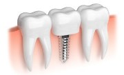 имплантация зубов без операции