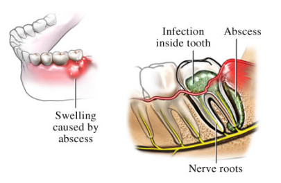 Абсцесс зуба на схеме