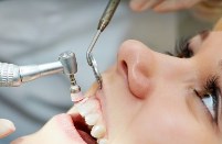 как проводится профессиональная чистка зубов