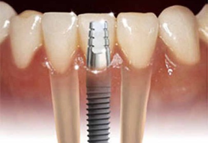 Пример протезирования зубов