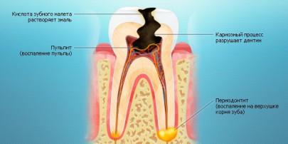 Зубные заболевания