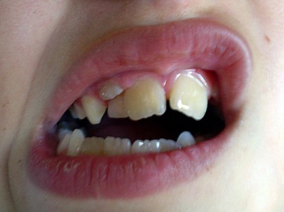Два ряда зубов