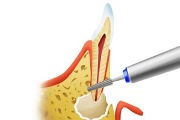 резекция зубного корня
