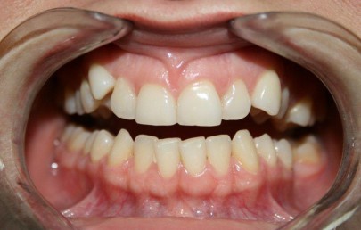 Ретинированный зуб