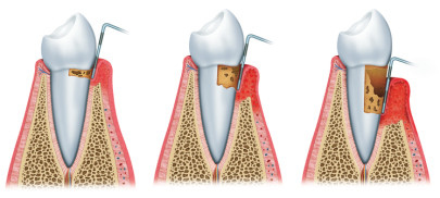Периодонтит – это одна из стадий заболевания, которое впоследствии переходит в пульпит, где воспаление распространяется по всей поверхности зуба.