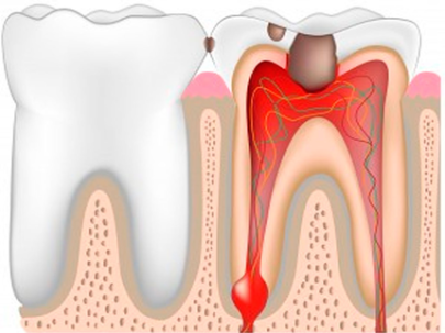 Периостит является проявлением различных стоматологических болезней и осложнение. 