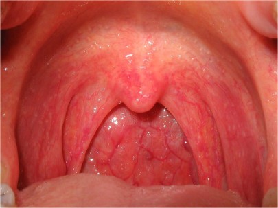 Болезнь внутри полости рта