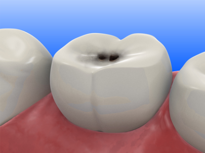 При кариесе разрушается эмаль зубов и появляется боль