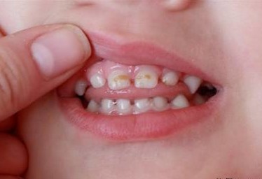 Кариес возникает не только на постоянных зубах, но и на молочных