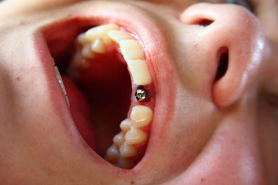 Перед имплантацией специалист проводит полную и тщательную диагностику полости рта.