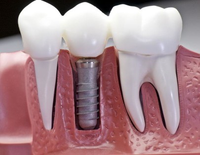 Импланты практически не отличаются от здоровых зубов. 