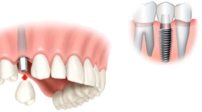 Лазерная имплантация является нововведением в стоматологии и протезировании. Здесь для осуществления необходимых разрезов используется луч лазера. 