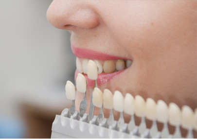 Пациентам следует знать, что в отличие от капы, виниры предполагают предварительную обточку зубов.