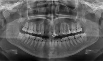 На панорамном снимке видно челюсти, пазухи носа, кости, которые находятся возле зубов.