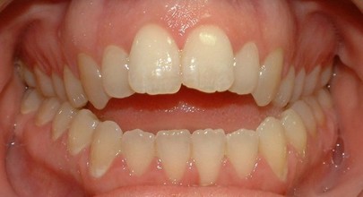 При открытом прикусе нет смыкания между зубами, причем щель может образовываться достаточно приличная, как на переднем участке, так и на боковом.