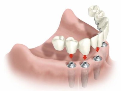 Имплантация зубов представляет собой высокотехнологичный метод вживления искусственного зуба в челюсть человека