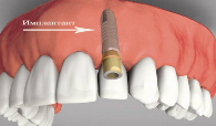 виды несъемного протезирования зубов