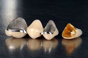 коронки на жевательные зубы