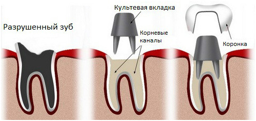 установка металлокерамических зубов