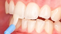 реминерализация зубов