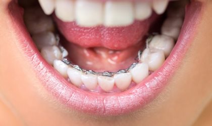 скобы на внутренней поверхности зубов
