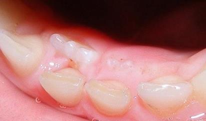 коренные зубы у детей