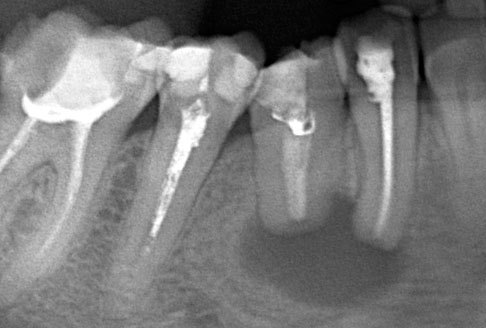 диагностика кист зуба