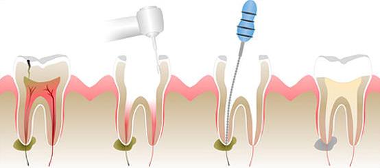 удаление зубного нерва