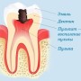 расположение нерва в зубе