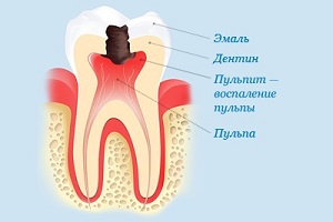 расположение нерва в зубе