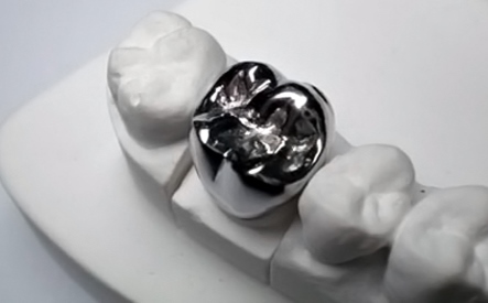 металл на жевательные зубы