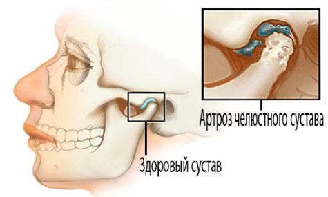 артроз суставов челюсти