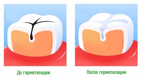герметизация зубов