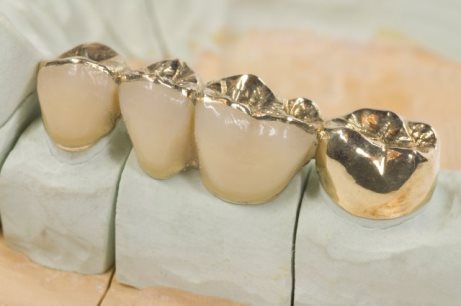 виды вкладок на зуб