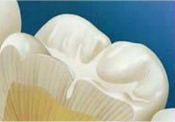 этапами герметизации зубов