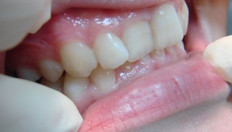 аномалия зубных рядов