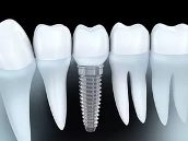 как долго приживаются зубные импланты