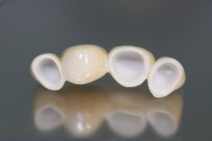 фарфоровые зубы
