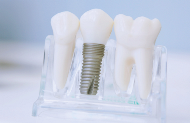 этапы имплантации зубов