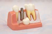  этапы имплантации зубов