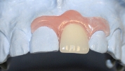 иммедиат протезы зубов